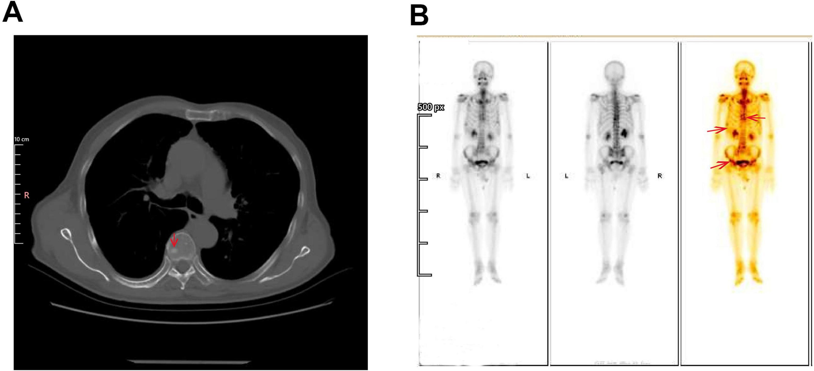Panel A shows a CT scan of the chest with a cross-sectional view, highlighting a specific area marked in red. Panel B displays three whole-body scans with different imaging techniques, including a color-enhanced image on the right where red arrows indicate specific regions of interest.
