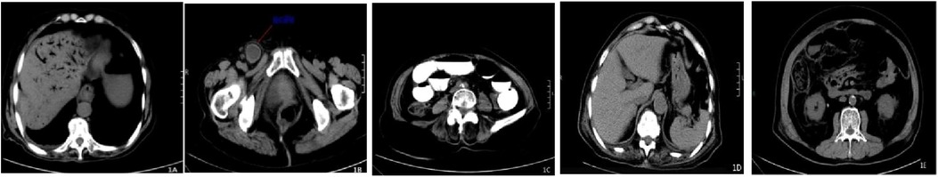 CT scan images showing five different axial views of the abdomen, each highlighting various internal structures such as bones, organs, and tissues. Each panel is labeled from 1A to 1E, demonstrating differing levels of density and contrast.