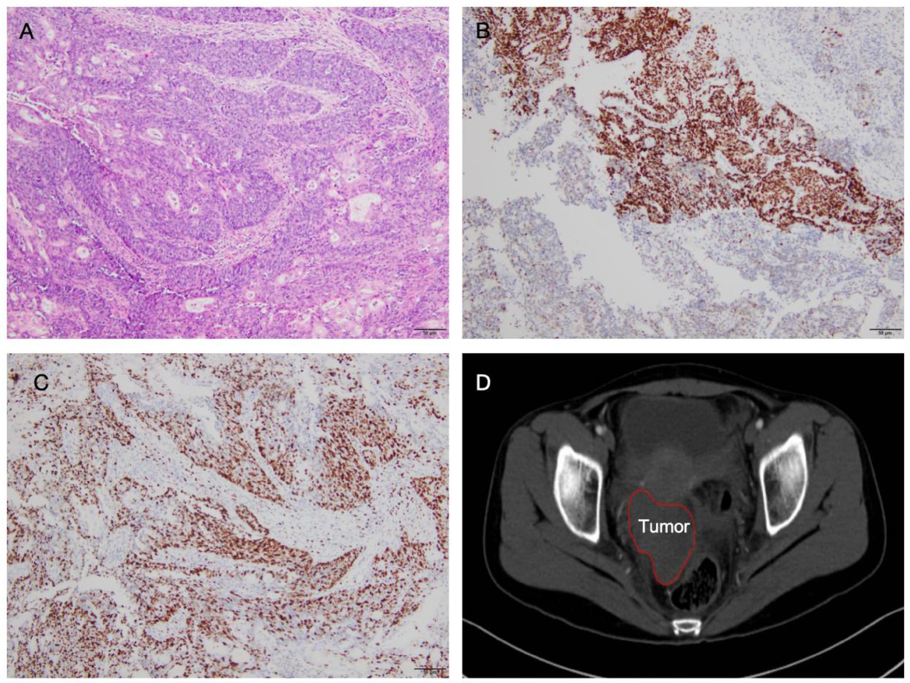 Four-panel image showing different views related to a tumor. Panel A shows a histological section with purple-stained cells, likely indicative of tissue structure. Panel B and C display sections with brownish staining, representing immunohistochemical analysis. Panel D shows a CT scan with a red outline marking the tumor location in the pelvic region.