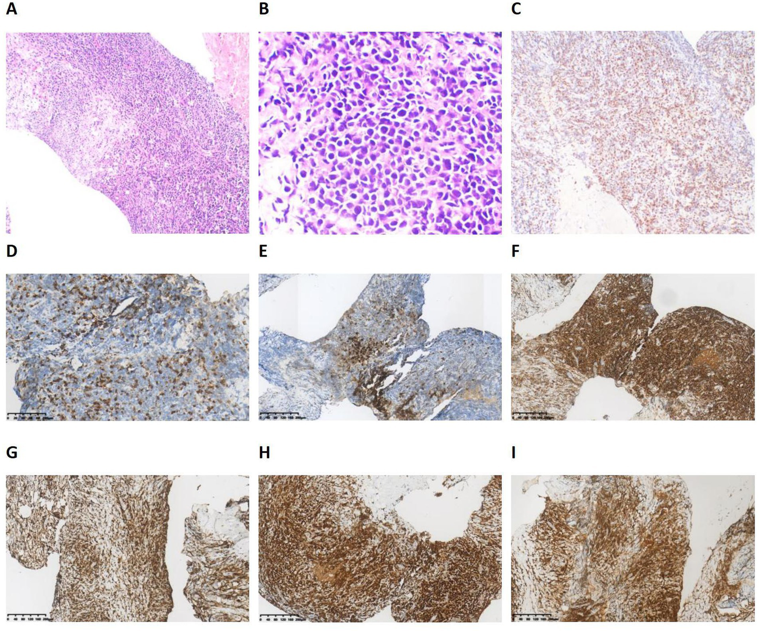 A set of histopathological images of tissue samples labeled A to I. Image A shows a low magnification view of tissue with invasion patterns. Image B shows a higher magnification of the same tissue, highlighting cellular details. Image C illustrates an immunohistochemistry stain indicative of certain protein expressions. Images D, E, and F display different staining intensities in blue and brown, showing varying protein presence. Images G, H, and I depict strong brown staining, indicating a high level of protein expression across different tissue sections.