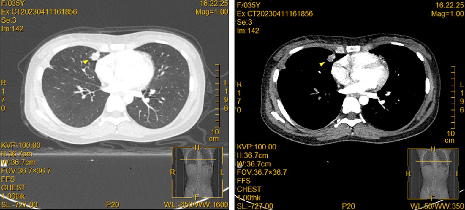 CT scan images of a chest, showing two cross-sectional views. The left panel displays lung tissue in greyscale, while the right panel has enhanced contrast, highlighting the heart and nearby structures. Both include measurement markers and technical data.