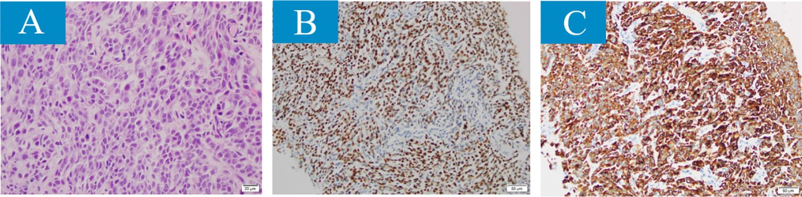 Three panel image showing histological views of tissue samples labeled A, B, and C. Panel A shows pink and purple stained cells with varied shapes, indicating cell density. Panel B features numerous brown-stained cells dispersed throughout the sample. Panel C displays densely packed cells with brown staining, highlighting areas of tissue. Each image includes a scale bar for reference.