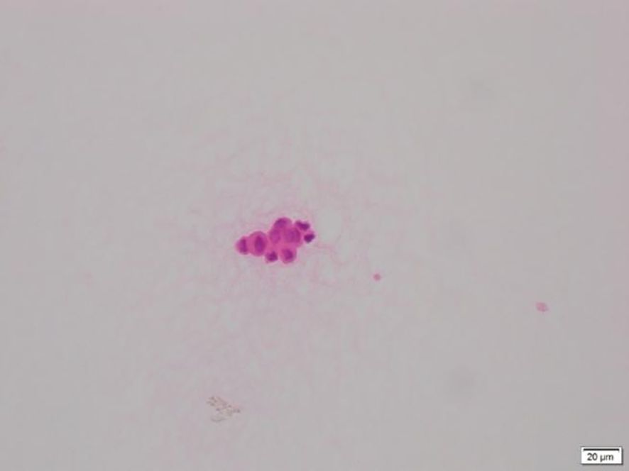 Microscopic view of a cell cluster stained in pink against a pale background. The cells appear clustered together, with a few individual cells visible nearby. A scale bar indicates 20 micrometers.