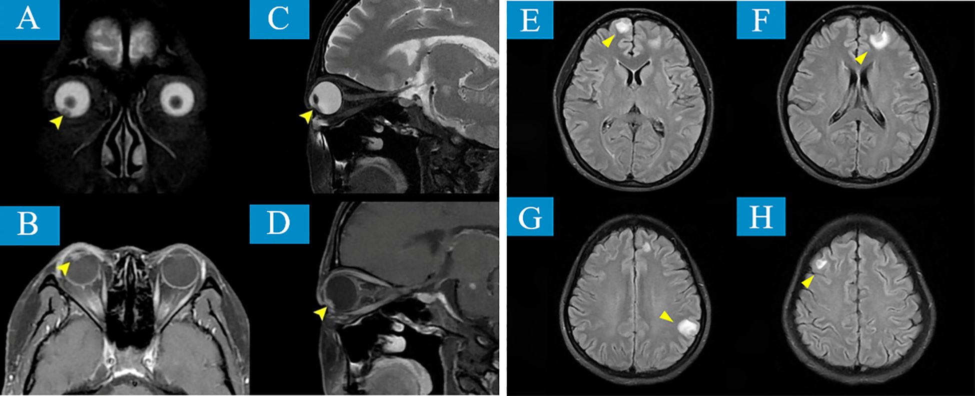 MRI scans showing various views of the brain. Panels A and B reveal lesions near the optical areas, highlighted with yellow arrows. Panels C and D are side views indicating similar findings. Panels E to H display transverse sections of the brain, with yellow arrows pointing to lesions in different regions.