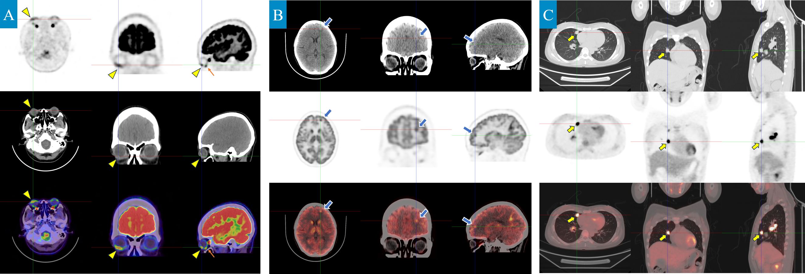 Medical imaging panels labeled A, B, and C depict various CT and PET scans of the brain and thorax in axial, coronal, and sagittal views. Arrows indicate focal areas of interest or abnormalities, highlighting different structures or changes in density. Each panel showcases different imaging modalities, combining grayscale and color-enhanced images to provide detailed visual assessments of anatomical regions.