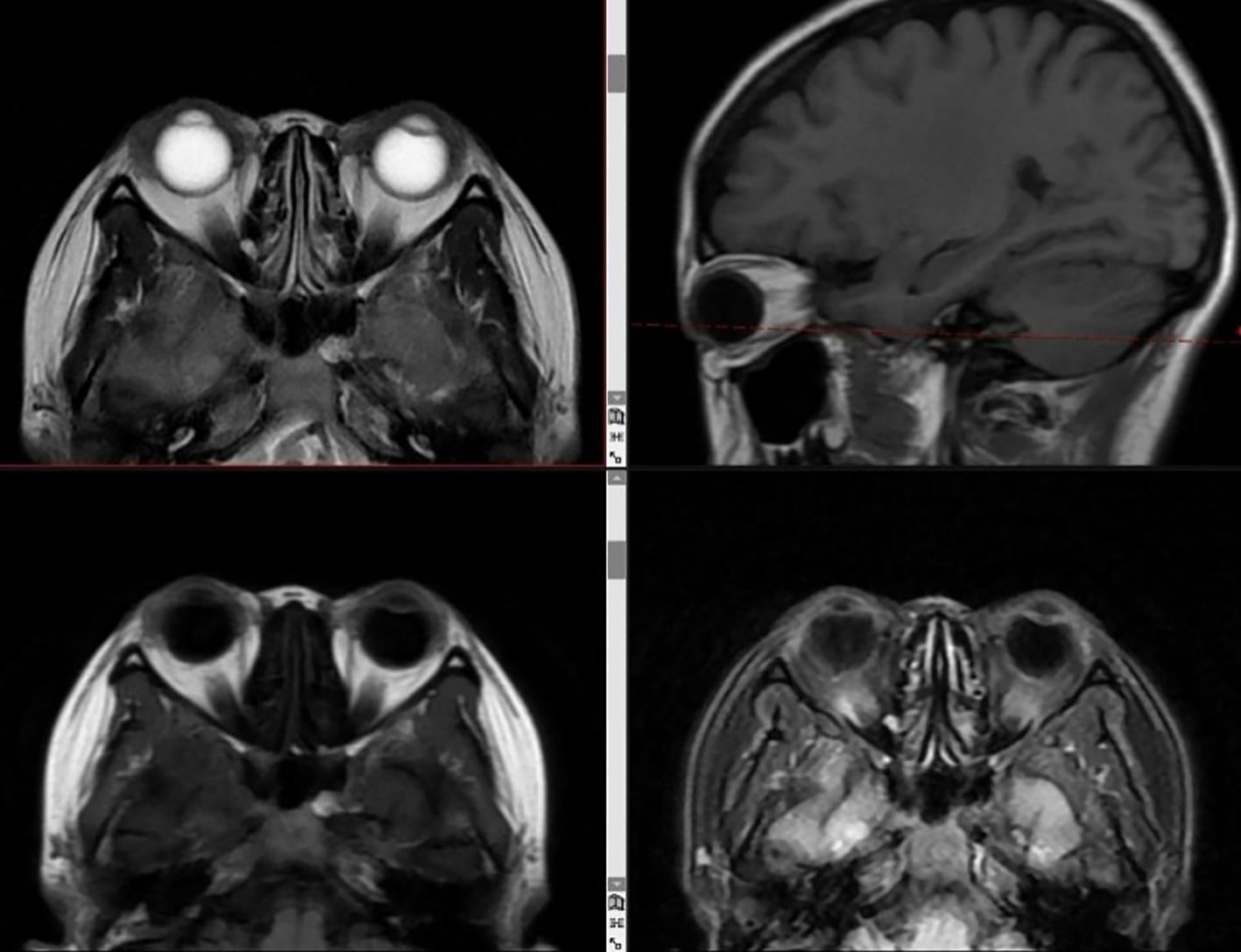 Four MRI scans show different views of the brain. The top left and bottom two images are axial cross-sections highlighting the eye sockets. The top right image is a sagittal view displaying brain structures and an eye socket in profile.