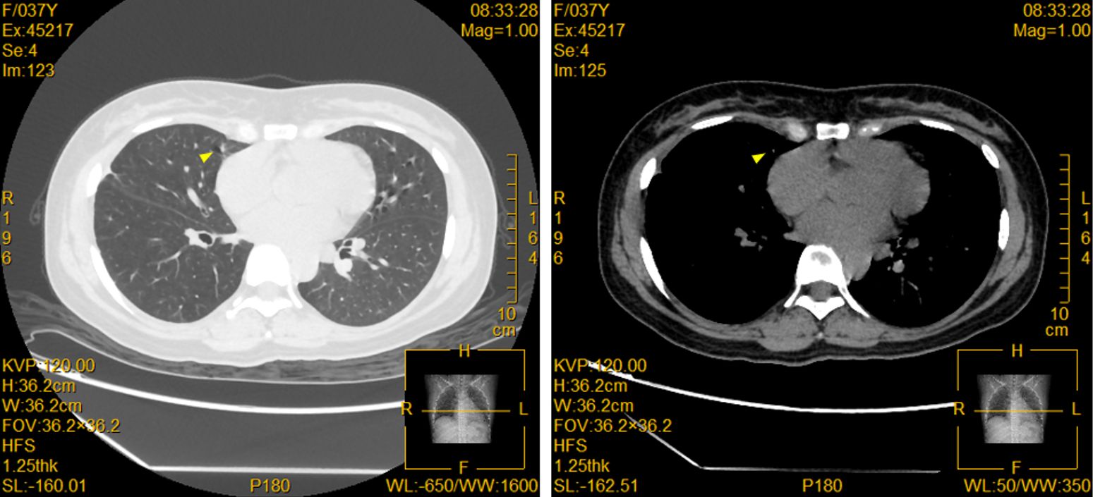 Two CT scan images side by side show the thorax. The left image uses a lung window setting, highlighting lung structures with a prominent arrow indicating a specific area. The right image uses a mediastinal window setting, offering more detail on the heart and surrounding tissues. Both images include measurement details and grid overlays.