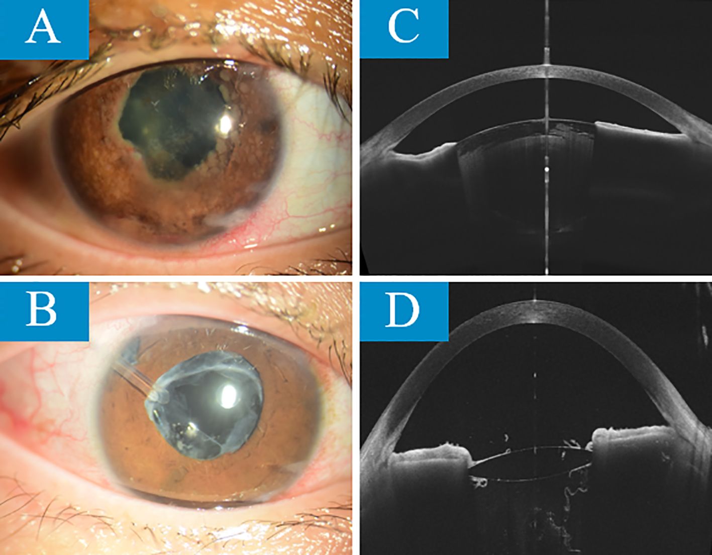 Close-up of two eyes and corresponding scans. Image A shows an eye with a dense cataract. Image B shows the same eye post-cataract removal with an implanted lens. Image C displays a scan of the eye from image A with the cataract. Image D shows a scan of the eye from image B with the clear lens implant.