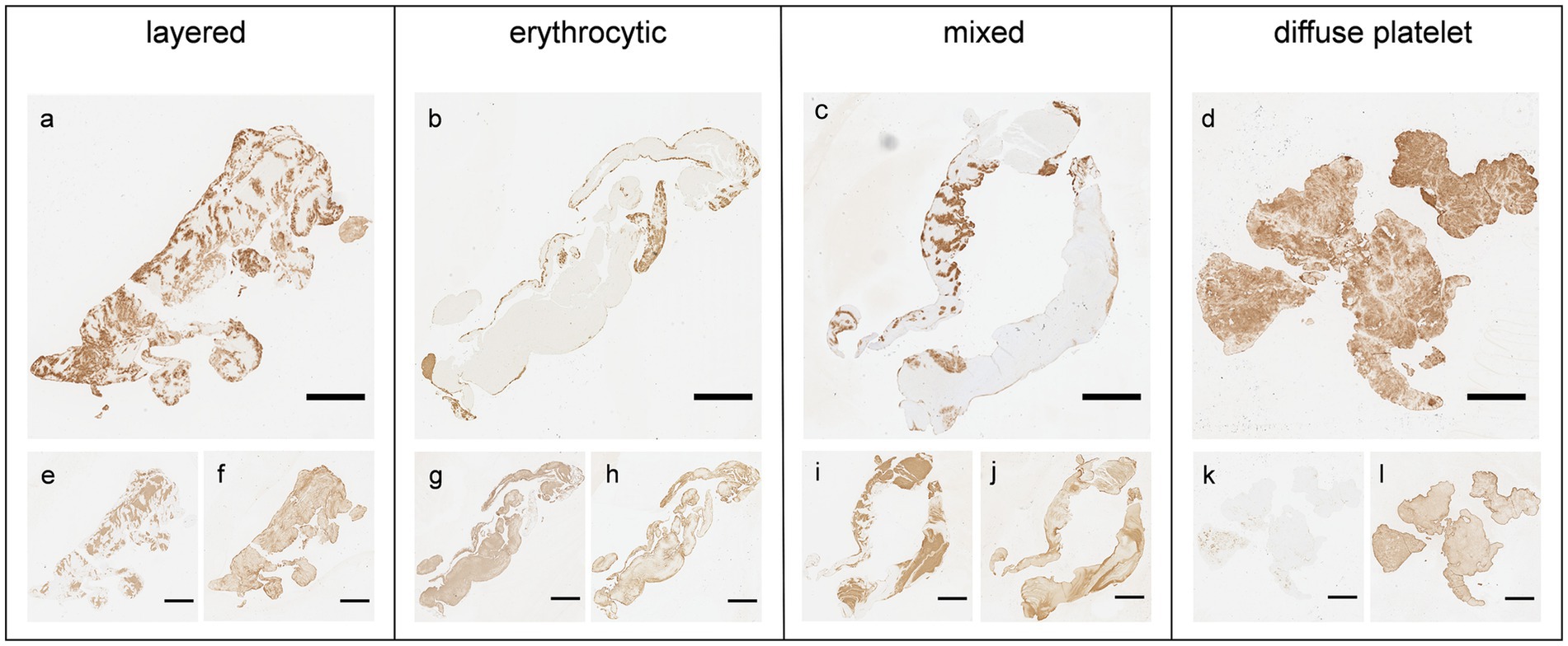 Microscopic images of thrombi with varying structures. Panels a, e, f show