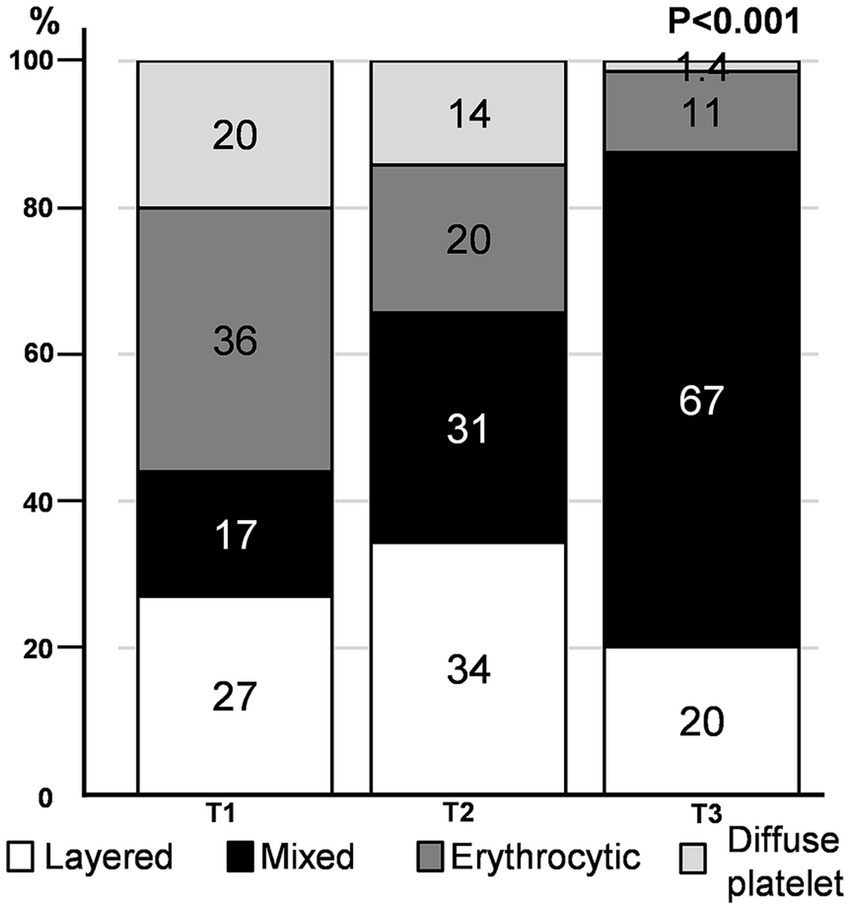 Stacked bar chart showing the distribution of four thrombosis types (layered, mixed, erythrocytic, diffuse platelet) across three time points (T1, T2, T3). T1 shows 27% layered, 17% mixed, 36% erythrocytic, and 20% diffuse platelet. T2 has 34% layered, 31% mixed, 20% erythrocytic, and 14% diffuse platelet. T3 reveals 20% layered, 67% mixed, 11% erythrocytic, and 1.4% diffuse platelet.