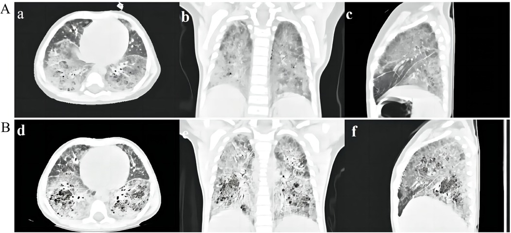 CT scans show two sets of lung images arranged in two rows labeled A and B. Row A includes images (a, b, c) showing lungs with patchy opacities, possibly indicating infiltration. Row B includes images (d, e, f) depicting reduced opacities compared to row A, suggesting improvement or treatment response. Images are captured in axial, coronal, and sagittal views, revealing structural details and differences between the two sets.