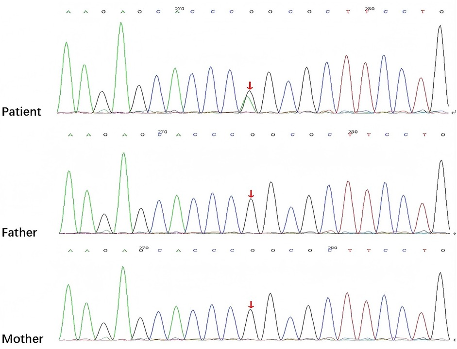 Genetic sequence chromatograms for a patient, father, and mother. Peaks indicate nucleotide bases: adenine (green), cytosine (blue), guanine (black), and thymine (red). Red arrows highlight specific base variations across sequences.