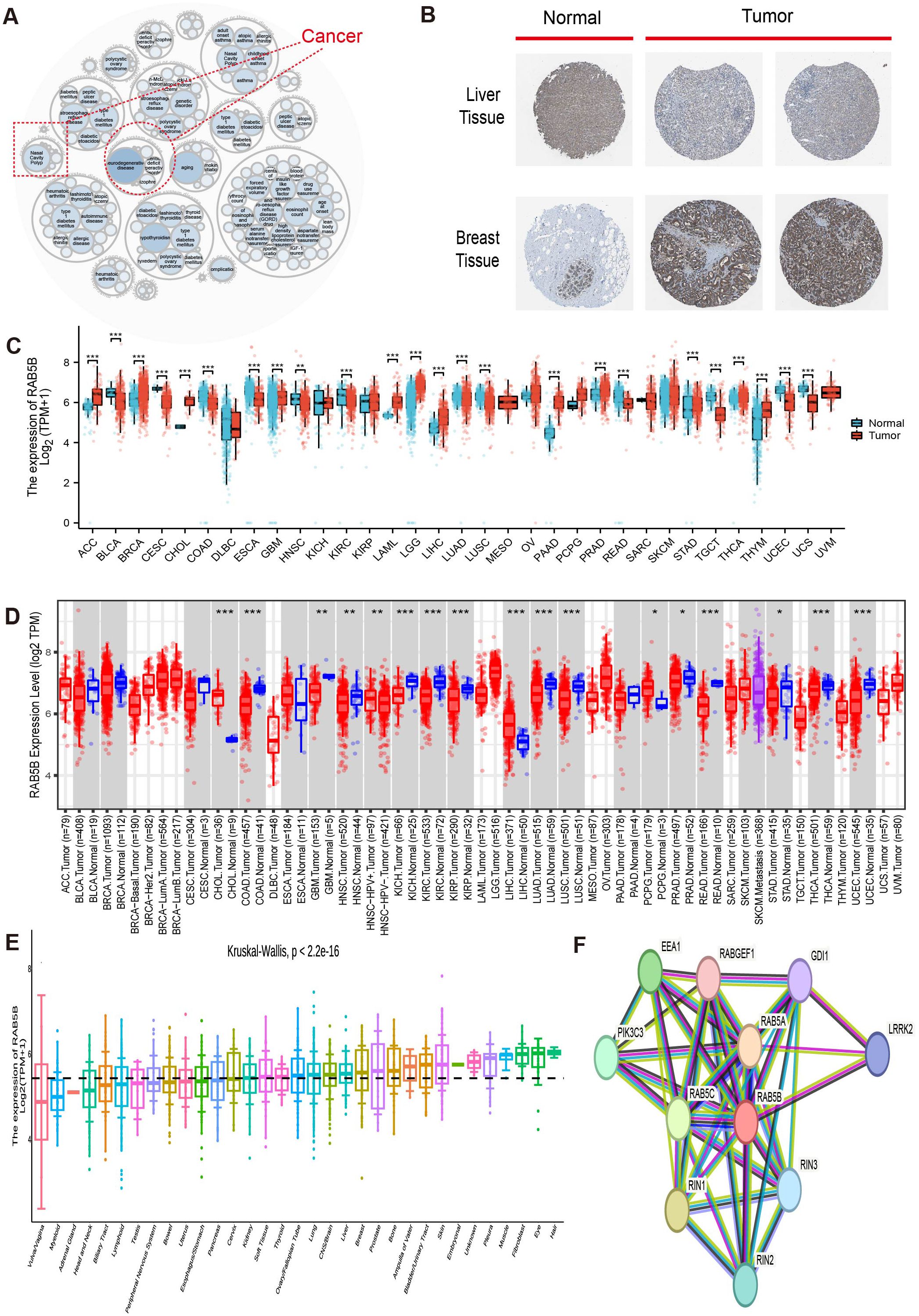 Diagram illustrating various data related to cancer research. Panel A shows interconnected concepts in cancer. Panel B displays tissue samples, including normal and tumor liver and breast tissues. Panel C presents a box plot comparing RAB35 expression in normal versus tumor tissues across multiple cancer types. Panel D shows another expression level analysis for RAB35. Panel E depicts differential gene expression using various colors for different experiments, with a Kruskal-Wallis p-value noted. Panel F is a network diagram showing interactions between proteins, including RAB35, with color-coded nodes and connecting lines.