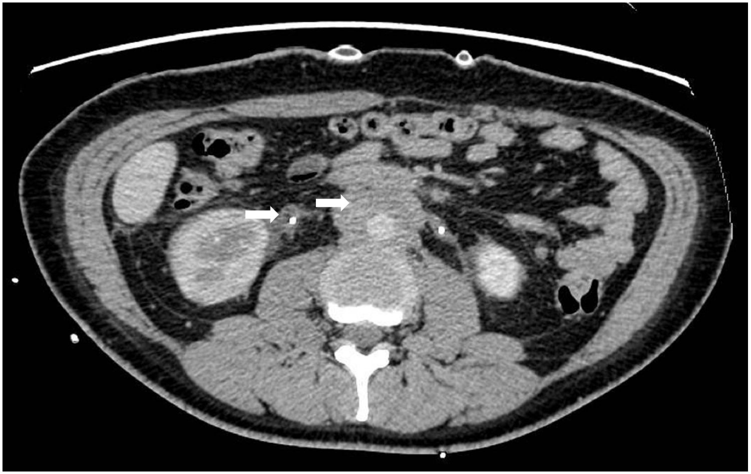 CT scan showing a cross-section of the abdominal region, highlighting various organs, tissues, and structures with varying densities. The image captures the intricate details of internal anatomy for medical evaluation.
