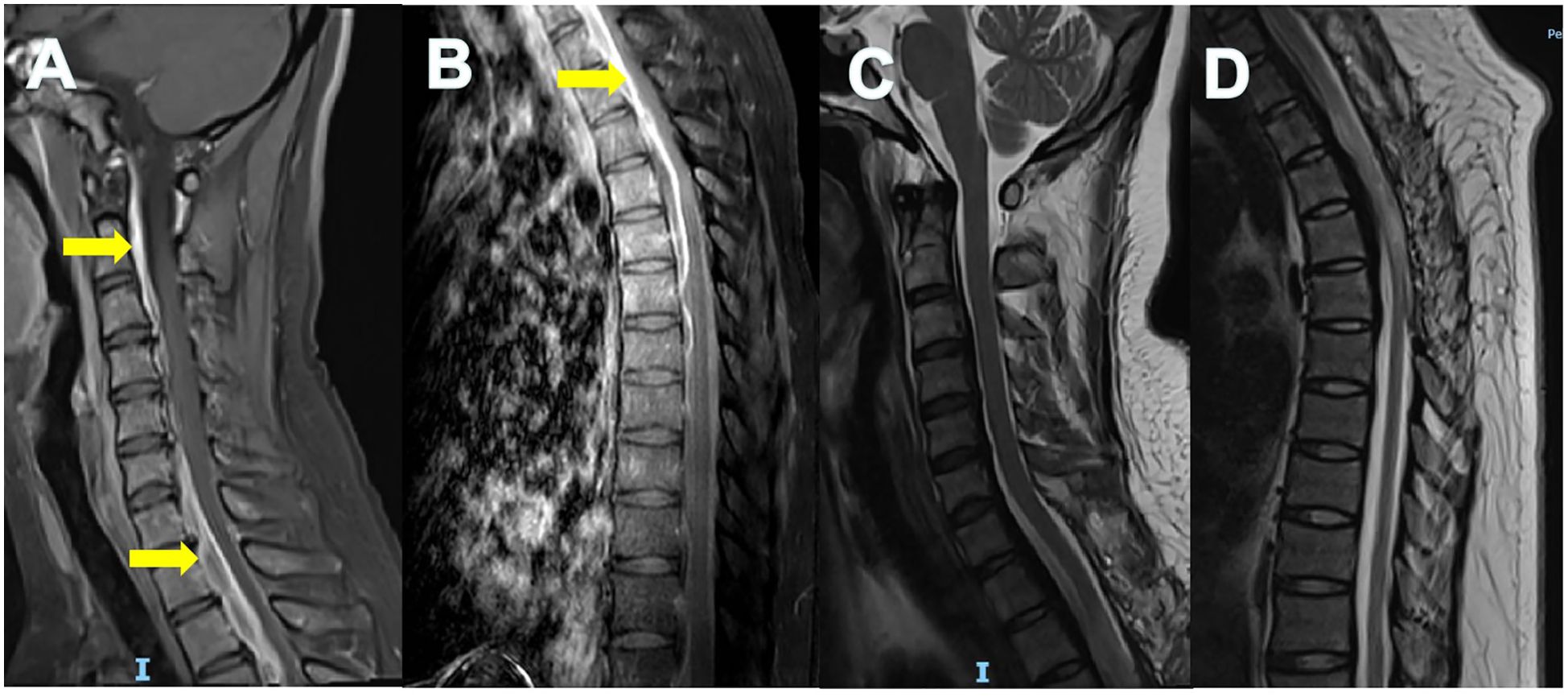 MRI scans of the spine are displayed in four panels labeled A to D. Image A and B show yellow arrows indicating abnormalities in the cervical spine. Images C and D illustrate different sections of the spinal column without marked indications.