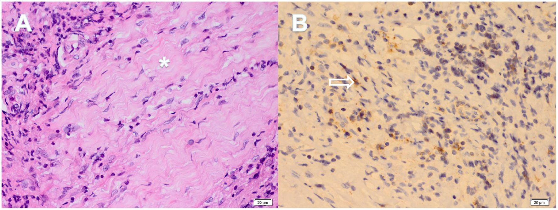 Section A shows a histological image with a pink background and scattered purple cells. A white asterisk marks a central area. Section B presents another histological sample with a beige background, displaying numerous blue and brown-stained cells, with a white arrow pointing to a particular feature. Both images have a scale measuring twenty micrometers for reference.