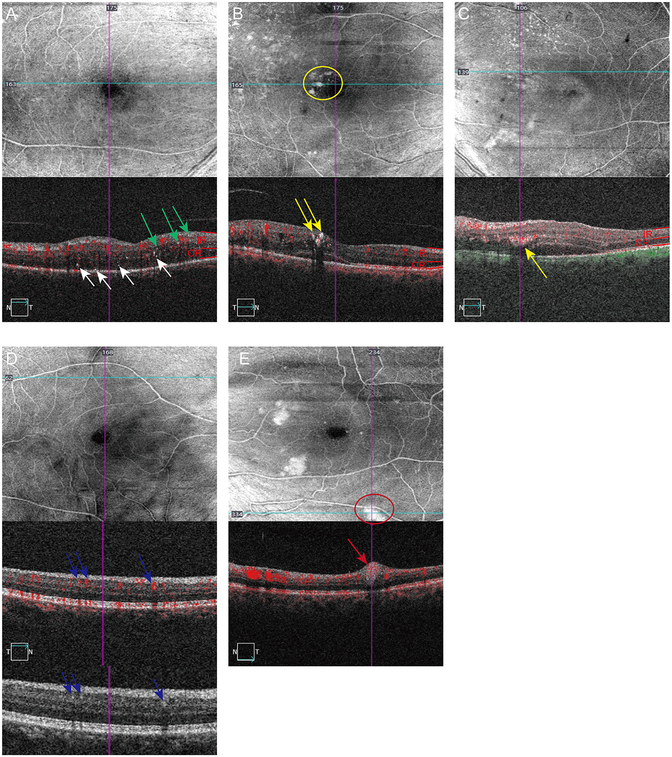 Five panels labeled A to E display retinal imaging scans. Panels A to E show cross-sectional scans with varied markings such as arrows and circles in different colors, indicating specific areas of interest or abnormalities on the retinal layers. Each panel includes both a top-down view and an associated cross-sectional image. Purple lines and measurement scales are present across the images for reference.