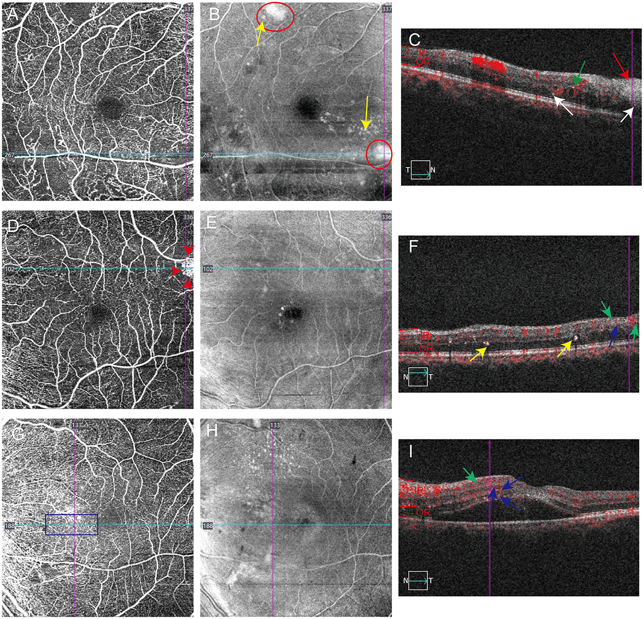 Three rows of medical imaging showing retinal scans with various annotations. Each row consists of three images labeled A to I. Row one highlights circles and arrows in images B and C, row two uses arrows and lines to indicate features in D and F, and row three includes a rectangle and arrows in images G and I. Each set appears to analyze vascular structures and retinal layers.