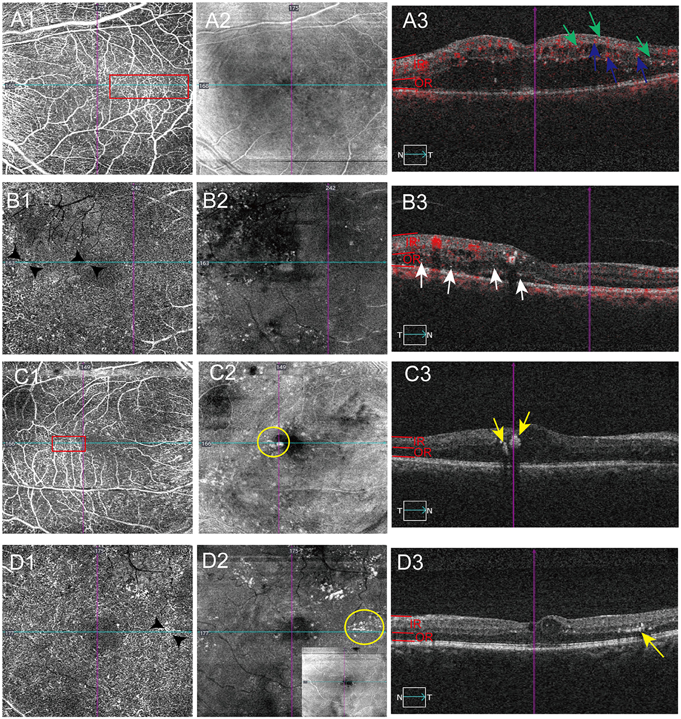 A set of four rows (A-D) of medical eye imaging showing different conditions. Each row includes three sections: A1-D1 and A1-D2 display vascular and retinal layers with various annotations like rectangles and circles highlighting areas of interest, and A1-D3 shows cross-sectional scans with arrows indicating specific features. The images consist of high-contrast details highlighting blood vessels and retinal layers alongside annotations suggesting significant findings, such as abnormal growth or lesions.