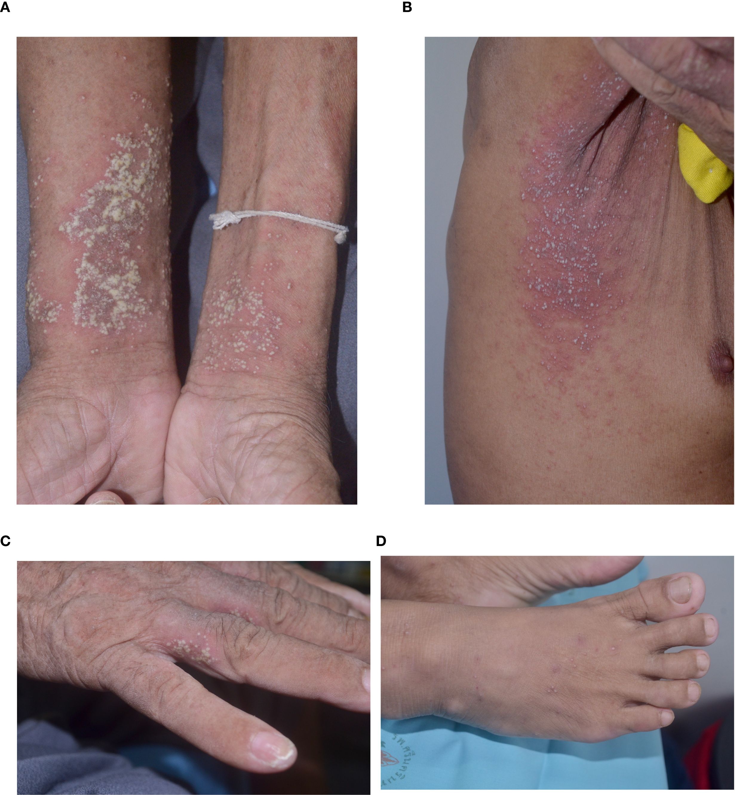 Four clinical images showing pustular eruptions with similar morphology, consisting of discrete pustules on an erythematous base at different anatomical sites. Image A: Forearms and wrists. Image B: Axillary region. Image C: Lateral fingers of the hand. Image D: Dorsum of the foot.