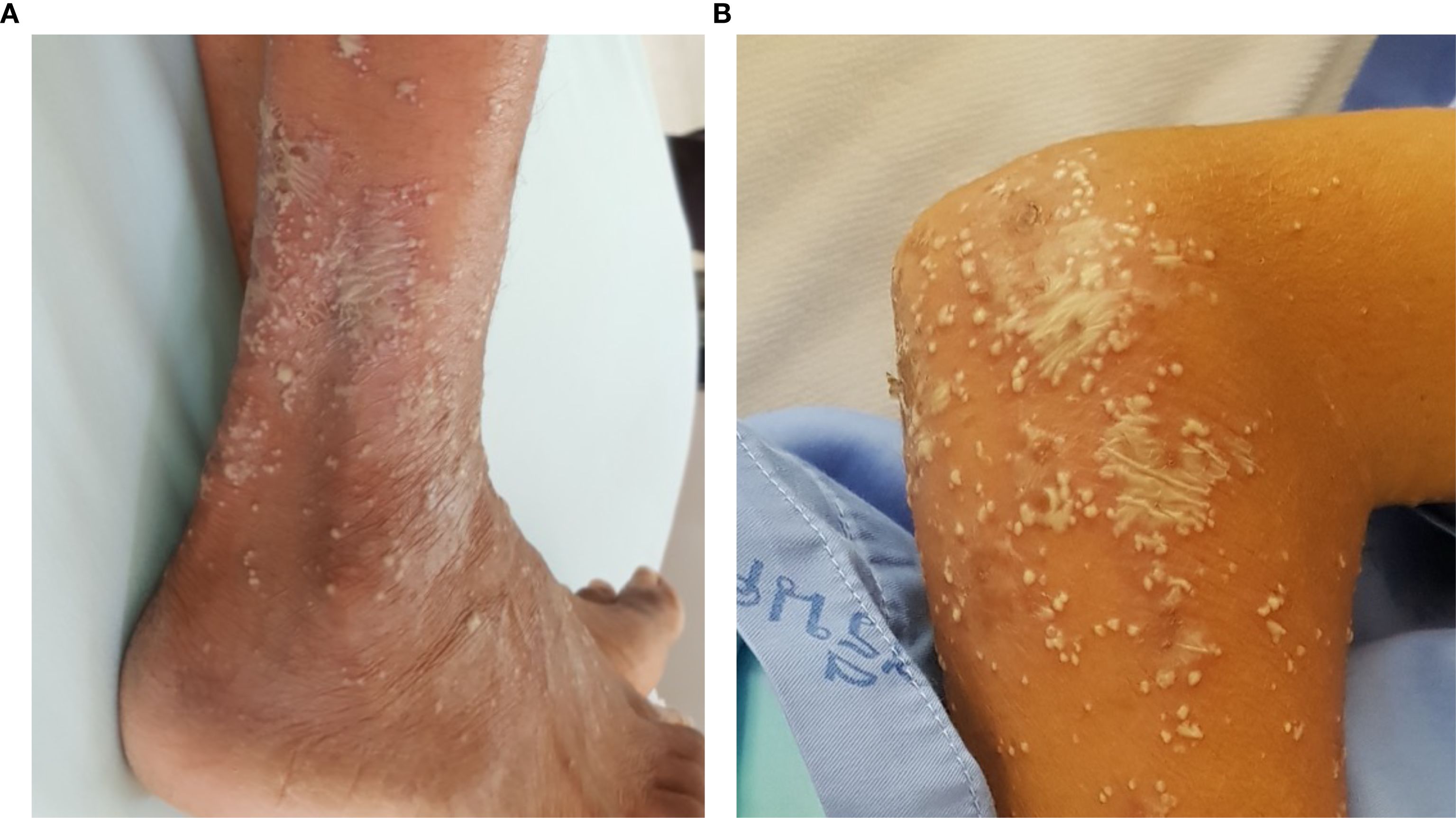 Two close-up clinical images showing discrete and confluent pustular lesions. Left: Ankle. Right: Elbow.