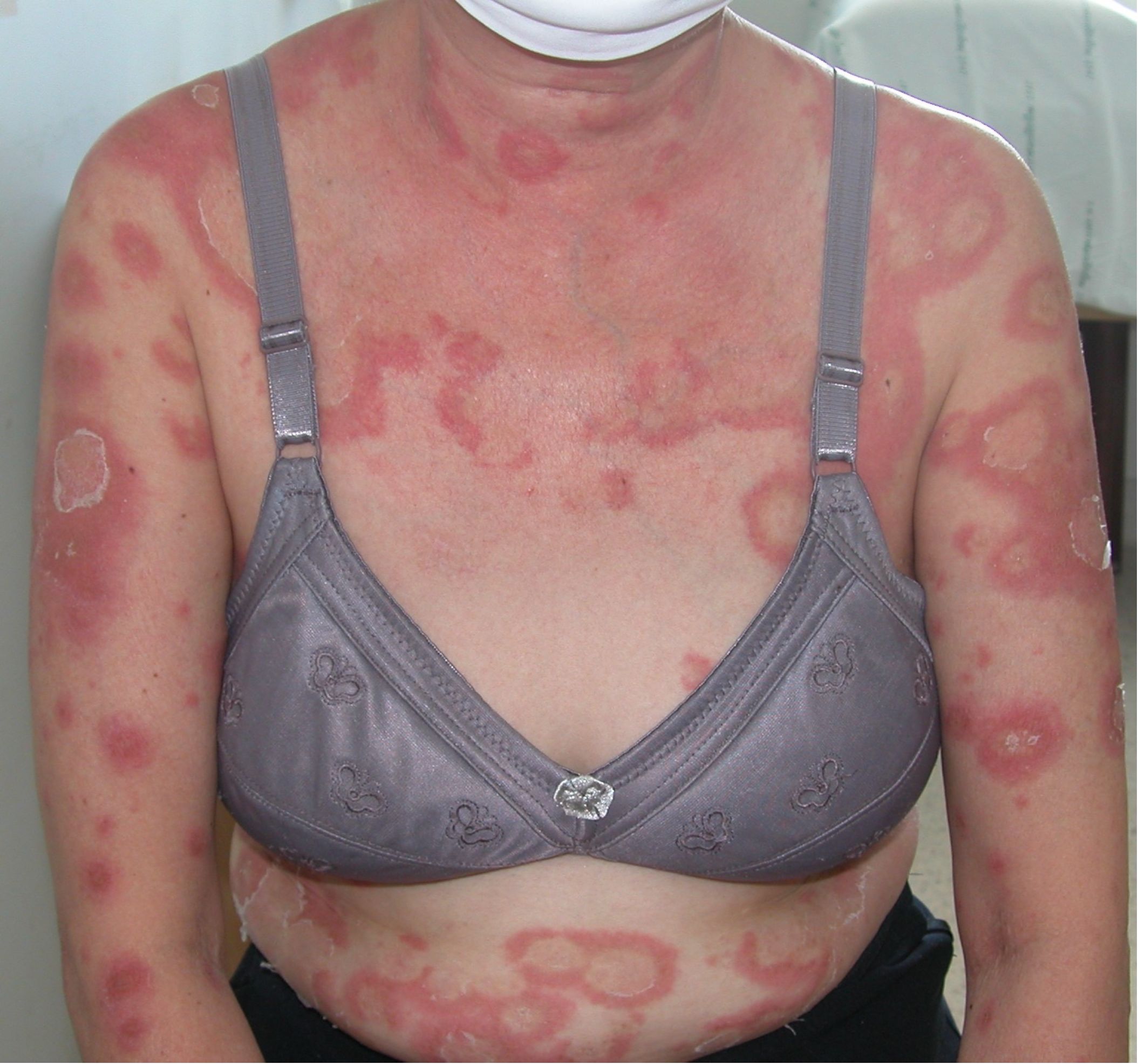 A patient with multiple circular erythematous patches with scaling on the chest and arms.