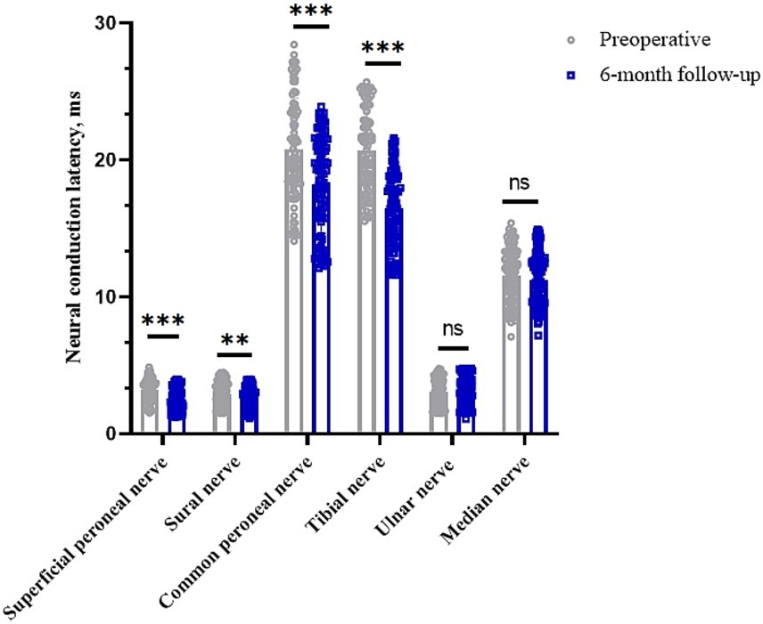 Bar graph depicting neural conduction latency in milliseconds for six nerves: superficial peroneal, sural, common peroneal, tibial, ulnar, and median. Gray bars represent preoperative data and blue bars show six-month follow-up data. Statistical significance is indicated with stars, showing significant differences in the superficial peroneal, sural, common peroneal, and tibial nerves, while ulnar and median nerves show no significant change.