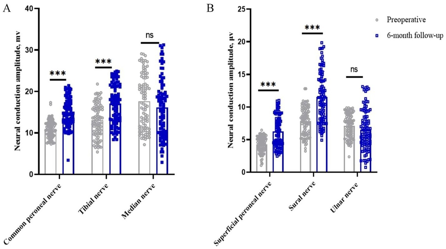 Bar graphs labeled A and B show neural conduction amplitudes for different nerves, comparing preoperative (gray) and six-month follow-up (blue) values. Significant increases (***), and non-significant changes (ns) are marked. Graph A presents data for the common peroneal, tibial, and median nerves, while graph B presents data for the superficial peroneal, sural, and ulnar nerves. Amplitudes are measured in millivolts (A) and microvolts (B).