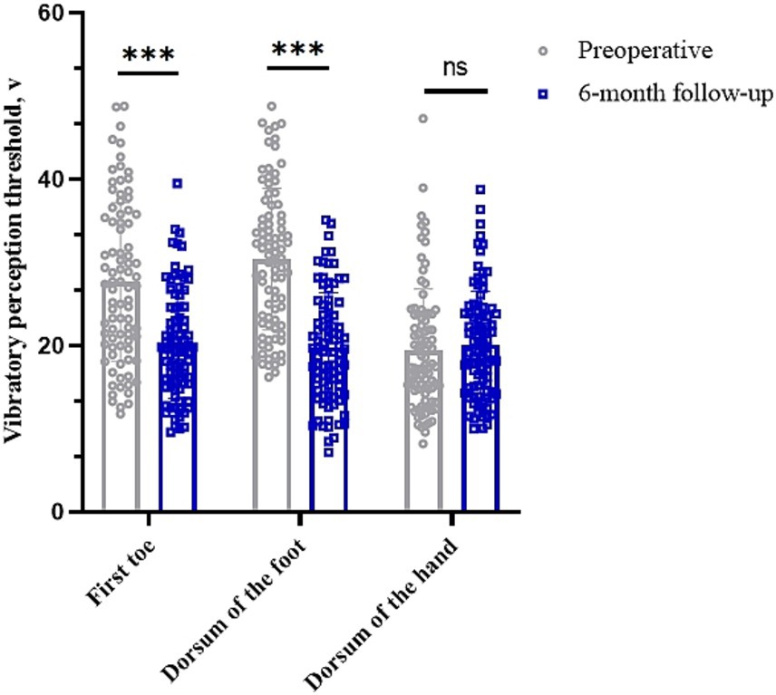 Bar chart comparing vibratory perception thresholds at the first toe, dorsum of the foot, and dorsum of the hand preoperatively and at six-month follow-up. Preoperative thresholds in gray circles and follow-up in blue squares. Significant differences, denoted by asterisks, are present at the first toe and foot, but not at the hand.