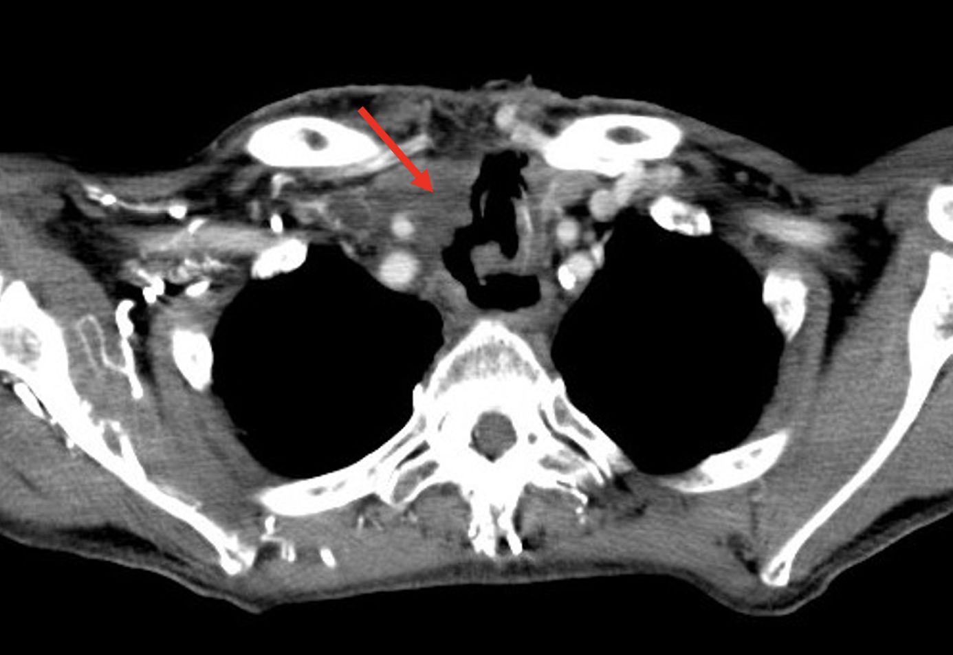 CT scan of the chest showing a transverse slice. A red arrow points to an area of interest, indicating a dark, irregularly shaped region in the soft tissue adjacent to the vertebra.