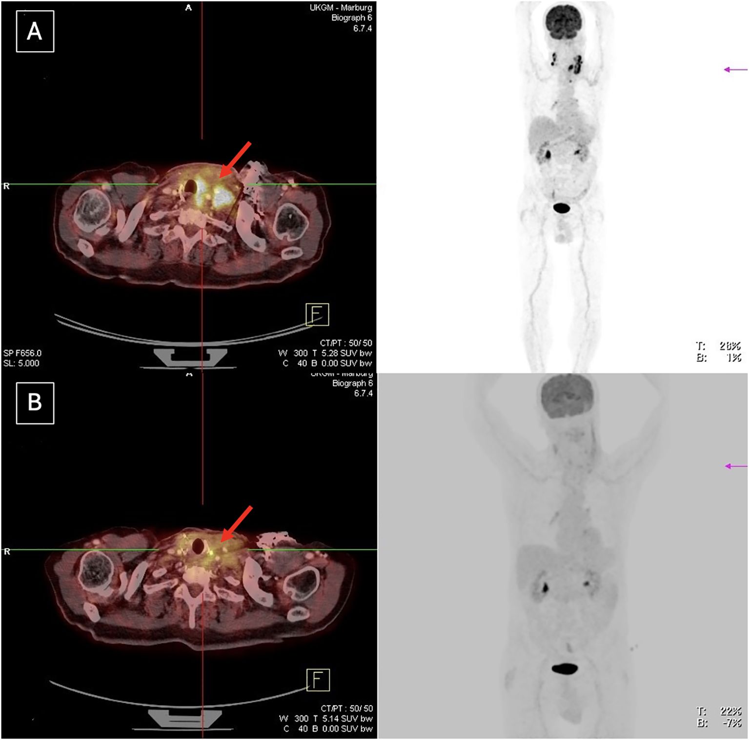Medical imaging showing two CT-PET scans with highlighted areas. The scans display cross-sectional views labeled A and B with arrows pointing to regions of interest. Adjacent images show full-body PET scans, one in higher contrast than the other.