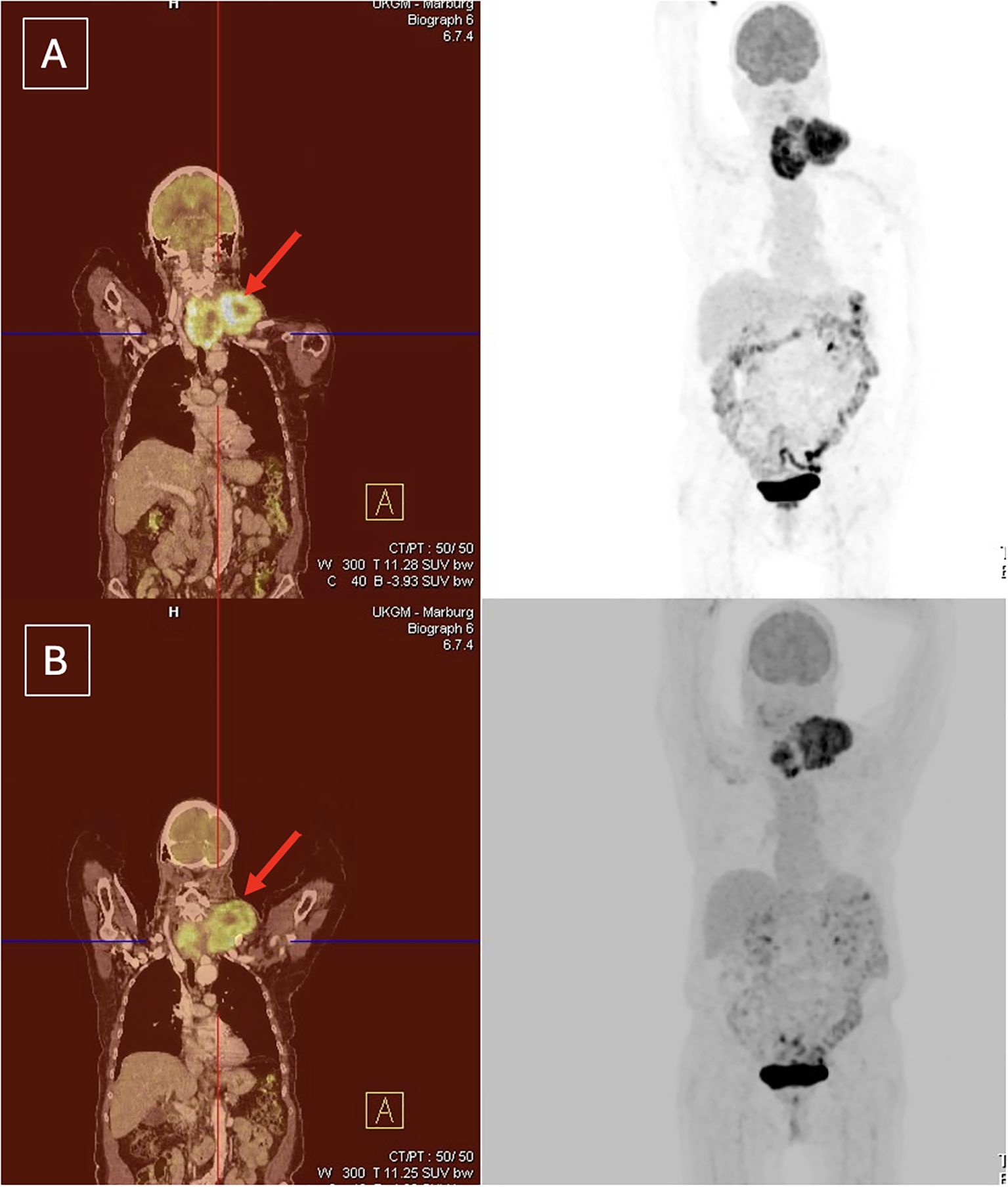 Two types of PET-CT scans are shown in side-by-side panels A and B. The scans highlight regions in the upper shoulder area with red arrows, indicating focal points on the left and grayscale scans on the right.