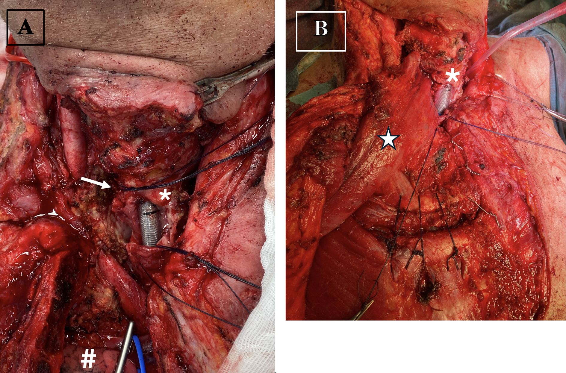 Surgical images showing detailed neck dissection in two panels. Panel A highlights muscles and visible blood vessels. Panel B shows the completed procedure with sutures and connective tissue. Both panels have symbols for reference points.