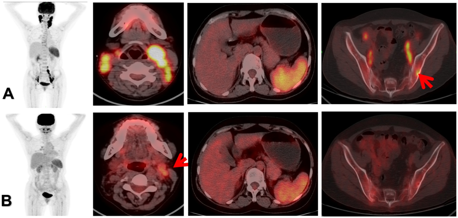 Two sets of medical imaging scans labeled A and B. Each set includes a full-body scan and three cross-sectional views. Both sets show areas of highlighted activity in similar regions, with red arrows indicating specific spots of interest in the cross-sectional scans.