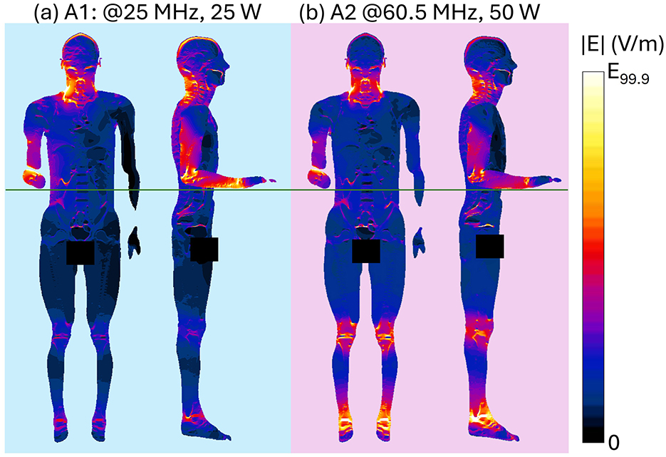 Two body heat maps showing electromagnetic exposure at different frequencies and power levels. Image (a) indicates 25 megahertz and 25 watts with a blue background, while (b) shows 60.5 megahertz and 50 watts with a pink background. A color scale on the right ranges 0 V/m to the value of the 99.9th percentile of the E-field distribution, represented by a gradient from blue to yellow.