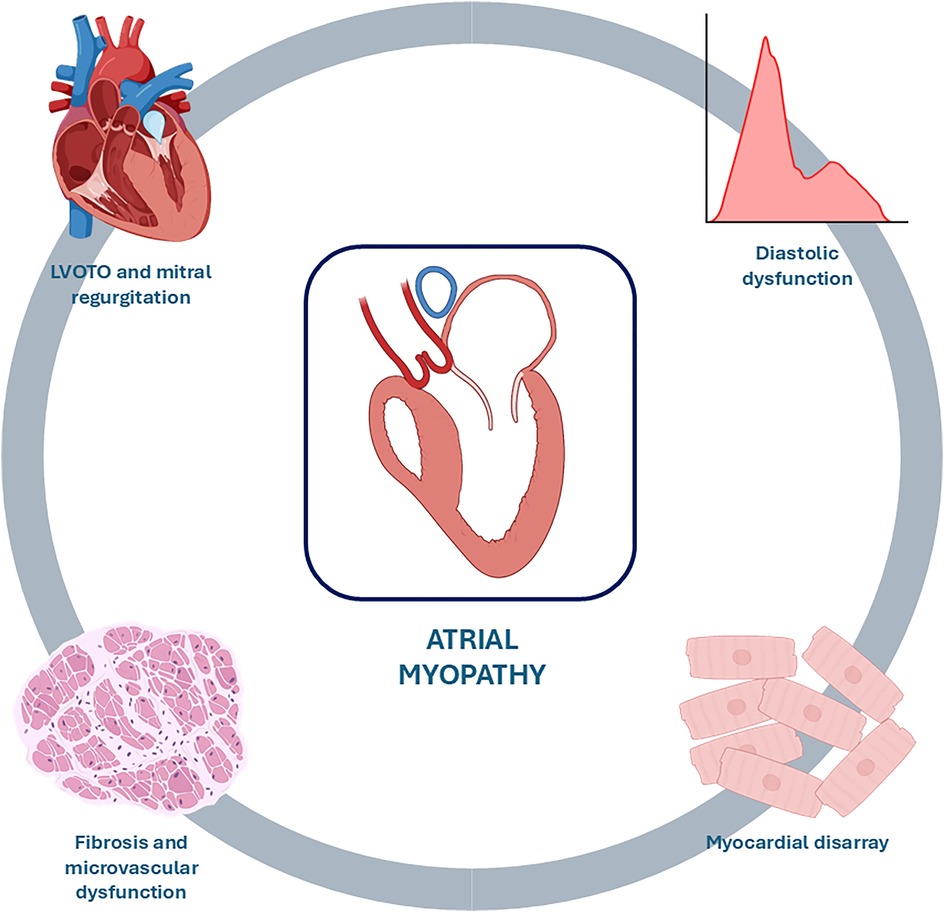 Diagram of atrial myopathy with a central image of a heart section. Surrounding elements include: a heart labeled \