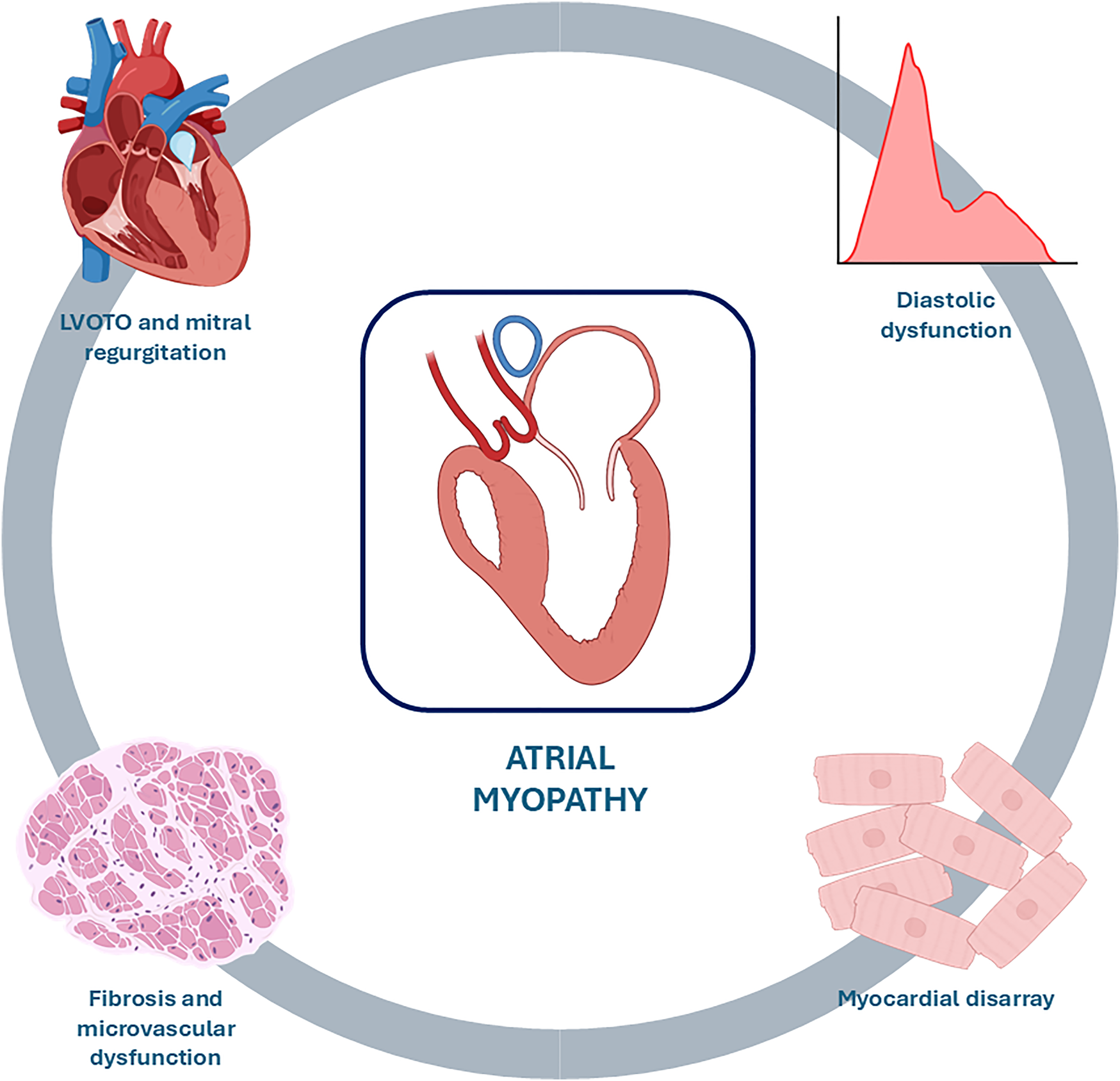 Diagram of atrial myopathy with a central image of a heart section. Surrounding elements include: a heart labeled \"LVOTO and mitral regurgitation,\" a chart labeled \"Diastolic dysfunction,\" an image of tissue labeled \"Fibrosis and microvascular dysfunction,\" and an illustration of cells labeled \"Myocardial disarray.\"