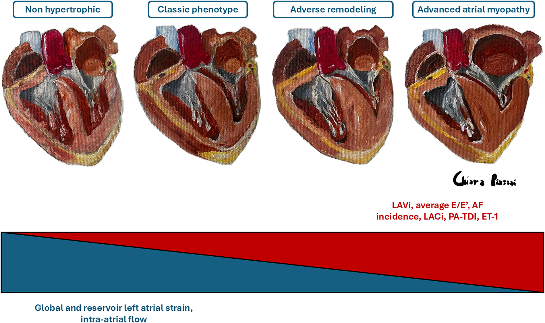 Illustration of four heart cross-sections labeled: \"Non hypertrophic,\" \"Classic phenotype,\" \"Adverse remodeling,\" and \"Advanced atrial myopathy.\" Below is a red and blue gradient bar. Blue represents \"Global and reservoir left atrial strain, intra-atrial flow,\" decreasing towards the right, while red, representing \"LAVi, average E/E’, AF incidence, LACi, PA-TDI, ET-1,\" increases.