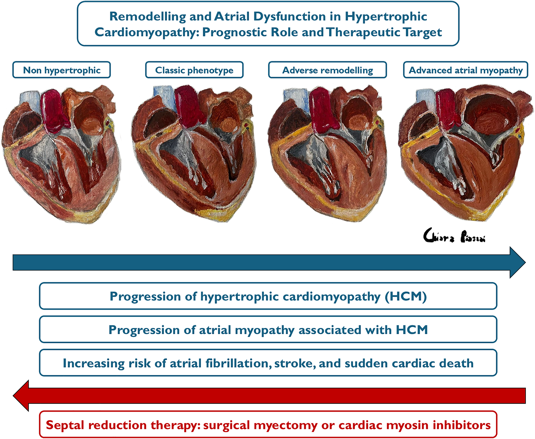Illustration showing the progression of hypertrophic cardiomyopathy (HCM) across four heart cross-sections: non-hypertrophic, classic phenotype, adverse remodelling, and advanced atrial myopathy. Below, text highlights progressive atrial myopathy, increasing risk of atrial fibrillation, stroke, and sudden cardiac death, with an arrow indicating septal reduction therapy as an intervention.