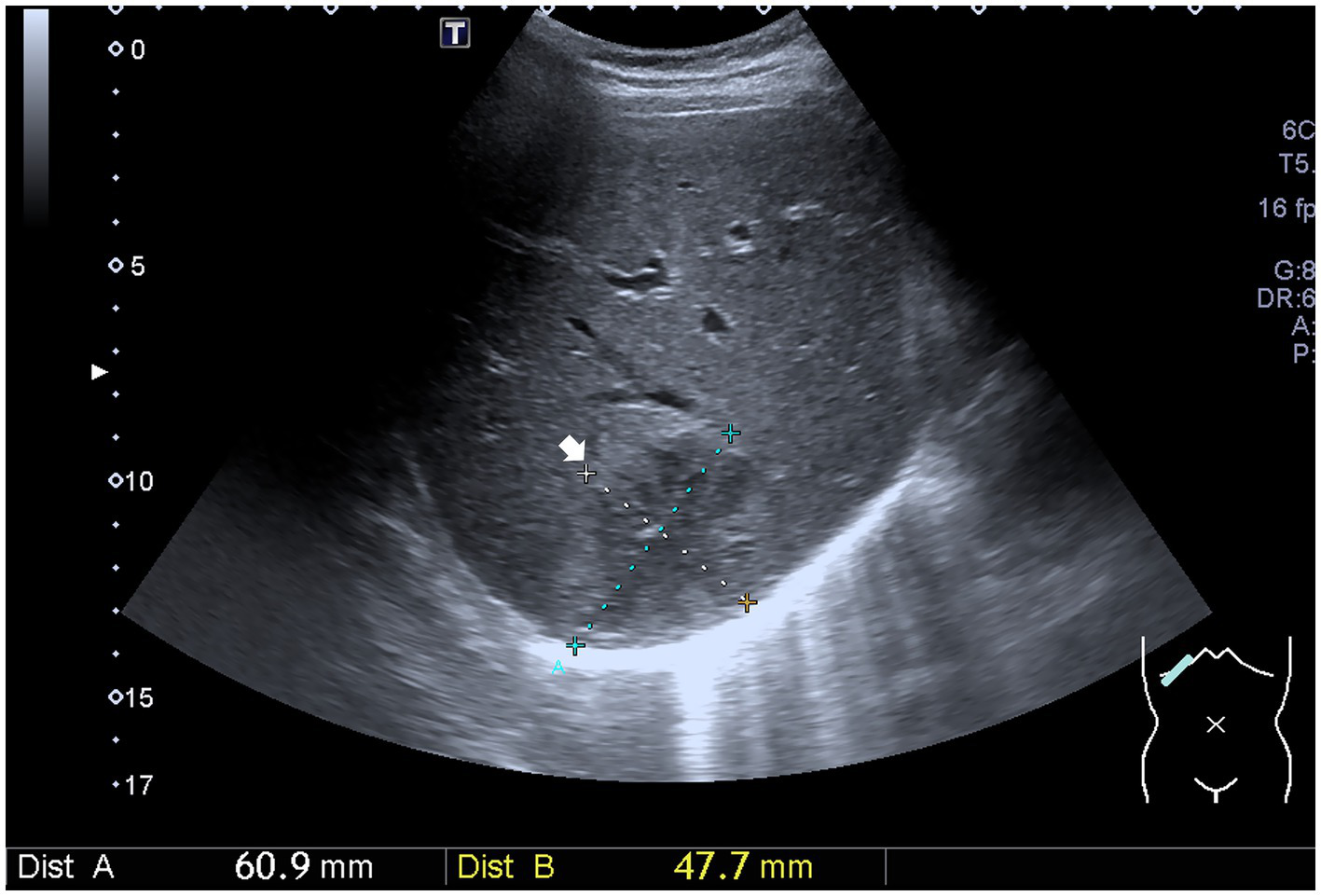 Ultrasound image showing a cross-sectional view of abdominal tissue. Measurement markers indicate two distances: 60.9 millimeters and 47.7 millimeters. Annotations and a diagram of the probe placement are visible on the right side.