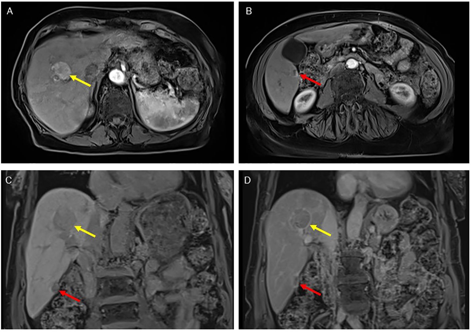 MRI scans of the abdomen in four panels labeled A, B, C, and D. Yellow arrows indicate lesions in the liver, while red arrows show additional abnormalities near the kidney area. Panels A and D display sagittal views; B and C display axial views.