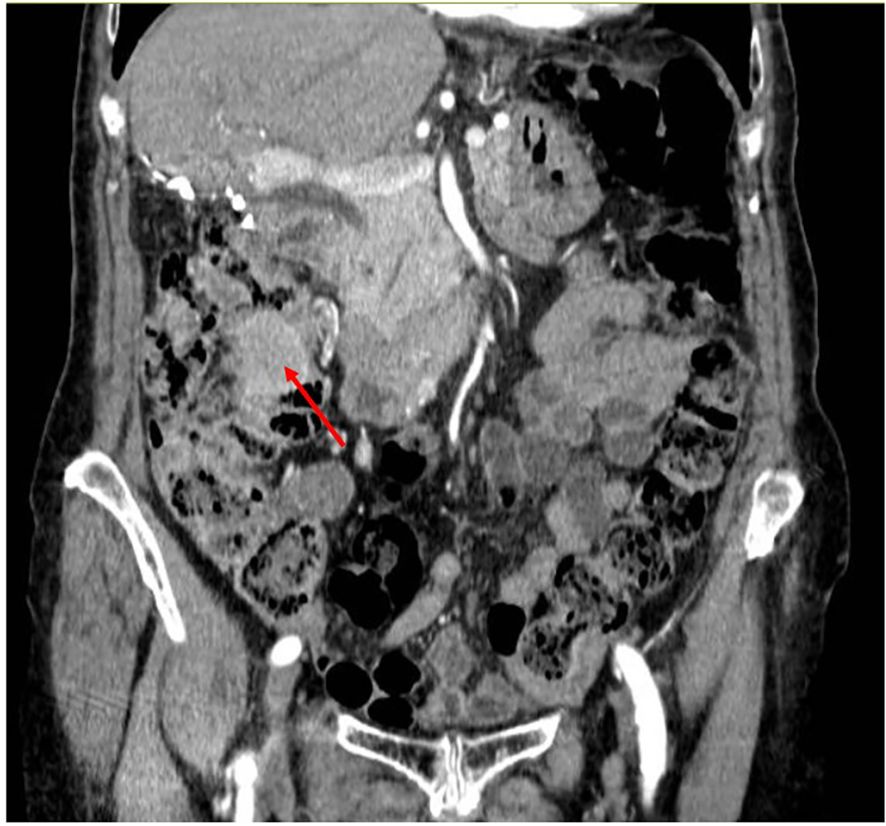 CT scan of the abdominal area showing a transverse view with a red arrow pointing to an area of interest, possibly indicating a lesion or abnormality in the digestive tract.