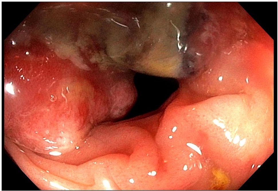 Endoscopic image showing an ulcerated and inflamed section of the intestine with visible reddish and darkened areas, suggesting the presence of tissue damage or disease.