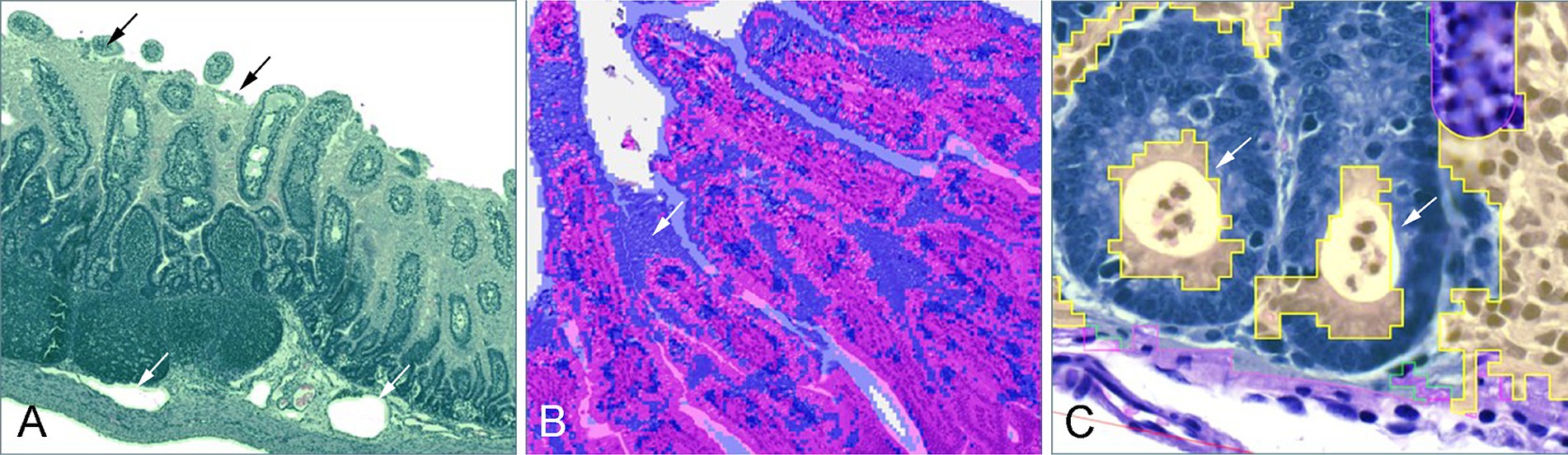 Image panel with three histological images showing frequently observed classification errors of the 3 step separation model. Image A show a jejunal segment with the green tissue-identification overlay. Black arrows point to areas where luminal content is classified as tissue. White arrows point at vascular structures classified as background. Image B shows jejunal villi with the blue and pink overlay from mucosal segmentation. The white arrow points to an area with epithelial vacuolization falsely classified as submucosal tissue. Image C shows two jejunal crypts with luminal neutrophils (crypt abscesses), and a yellow overlay falsely classifying the luminal cells as part of lamina propria.