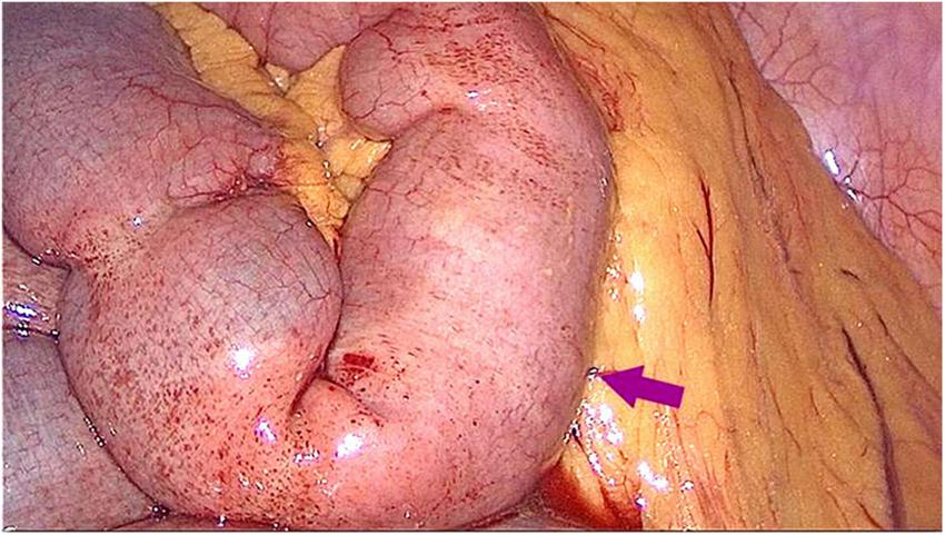 Close-up image showing the interior of a body, likely the intestinal area, with a prominent bulging section. An arrow points to a specific spot, highlighting it for emphasis. The surrounding tissue appears fleshy and moist.
