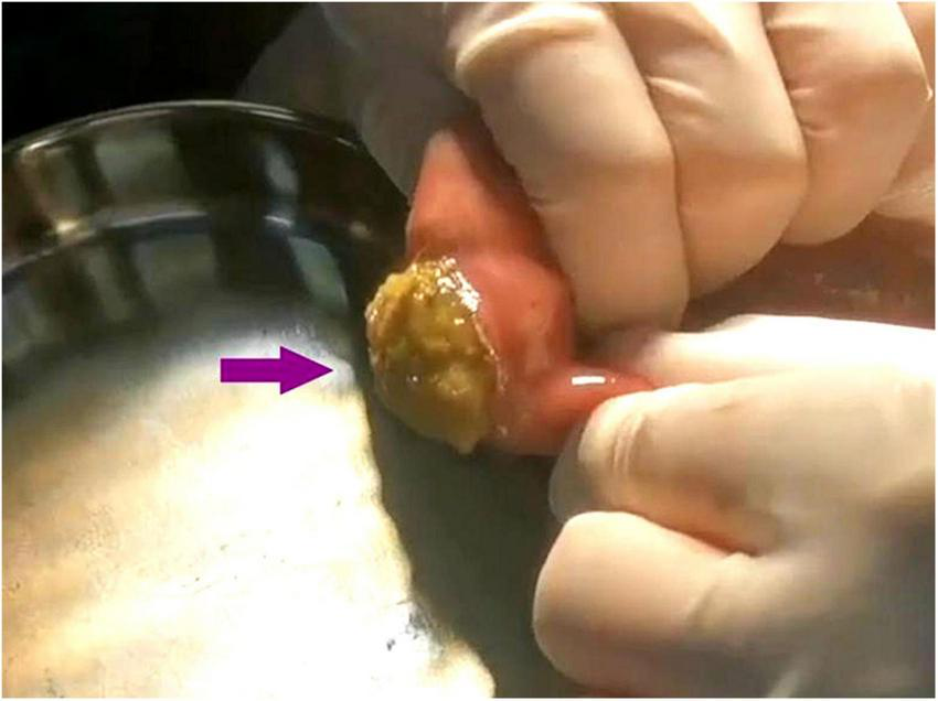 Gloved hands applying pressure around an inflamed area on a person’s skin, near a metal dish. An arrow points to a yellowish, raised lesion or abscess being examined.