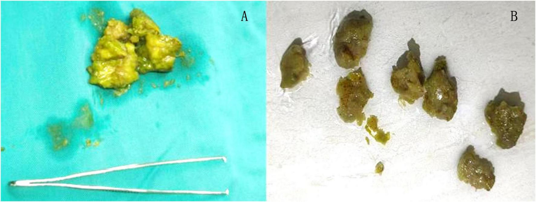 Panel A shows a large cluster of yellow-green stones on a blue surgical drape next to forceps. Panel B displays several smaller yellow-green stones spread out on a white surface.
