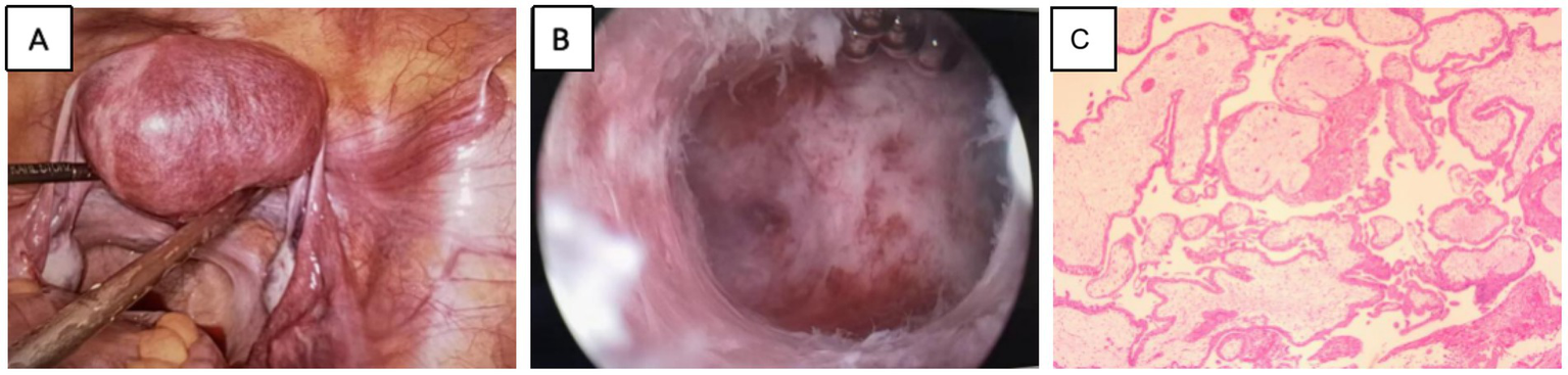 Surgical and pathological images. A: Laparoscopy reveals a mass in the uterine muscle layer. B: Hysteroscopic removal of a gestational sac within the uterine muscle layer. C: Postoperative pathological confirmation of IMP.