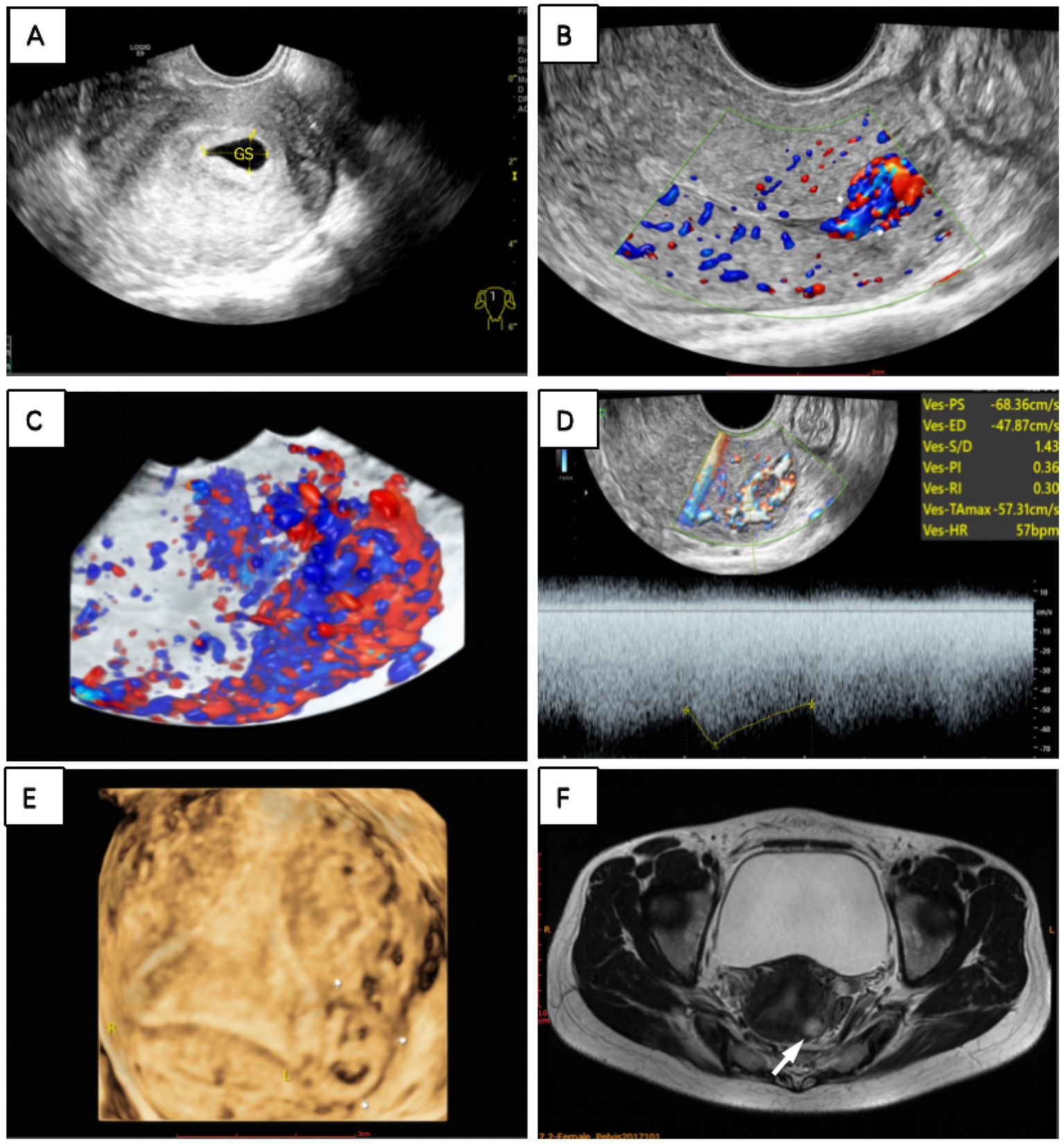 Different medical imaging diagnostic views of case 2. A: Ultrasound showing a gestational sac labeled “GS” in the uterus. B: Doppler ultrasound with colored blood flow areas two months after the miscarriage. C: Three-dimensional flow imaging showing red and blue flow. D: Doppler ultrasound with flow measurements displayed. E: 3D ultrasound image highlighting anatomical details. F: MRI scan with an arrow indicating a specific area in the pelvis.
