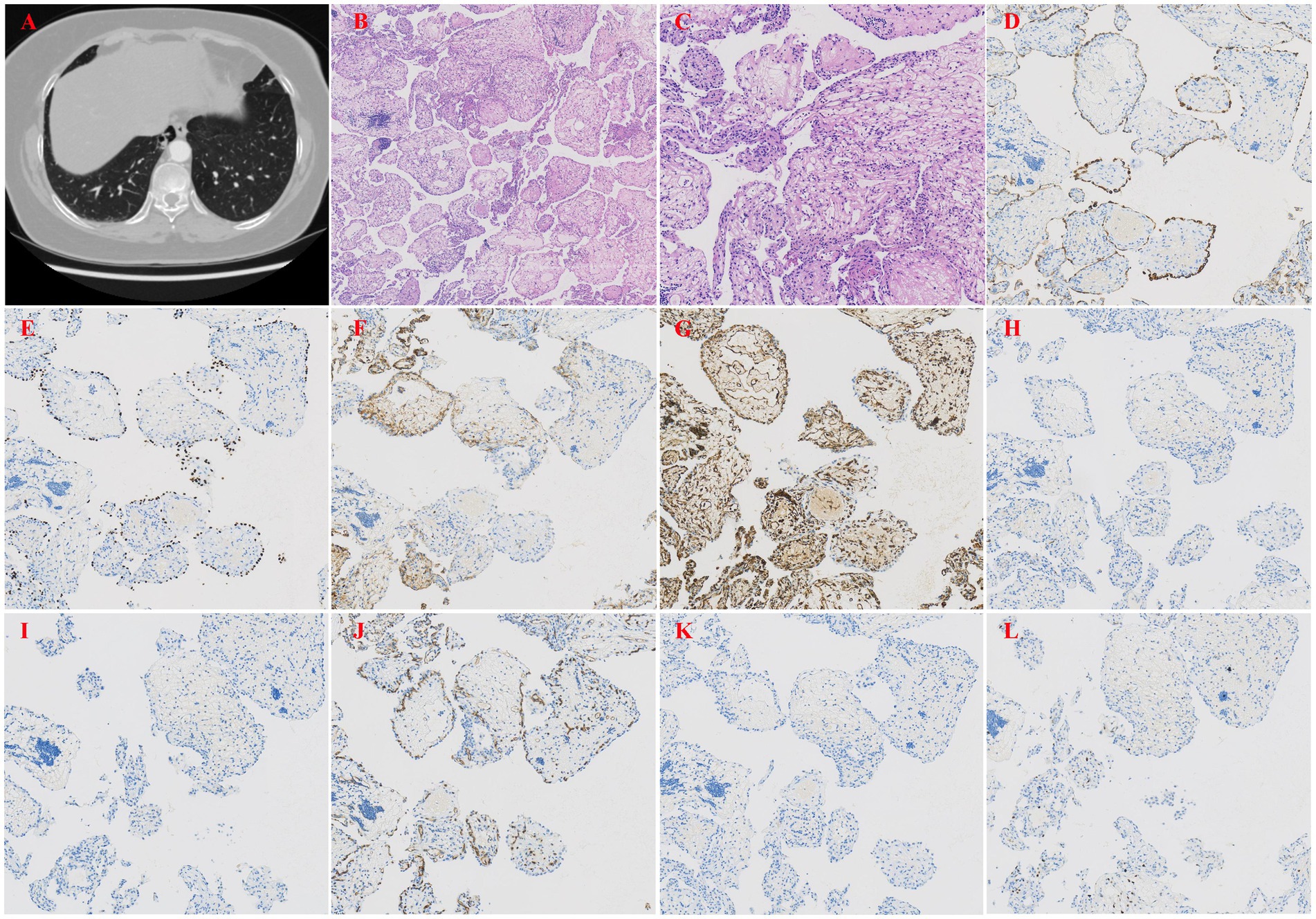 A series of medical images with panels labeled A to L shows various types of tissue samples and medical scans. Panel A displays a CT scan of lungs. Panels B and C are histopathology slides with different staining techniques, showcasing lung tissue structures. Panels D to L feature immunohistochemical staining images with varying degrees of brown and blue colors, indicating different protein expressions in lung tissue samples. Each panel highlights different aspects of lung pathology and diagnostic markers used in medical analysis.
